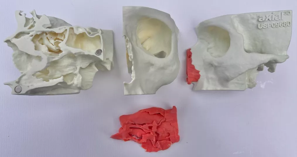 Multiple Components of a 3D Printed Maxillofacial Model 