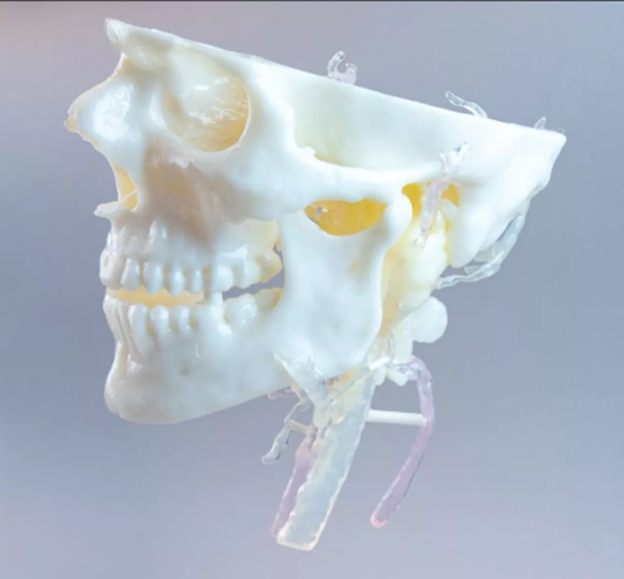 3D Printed Model of a Glomus Jugulare Tumor 